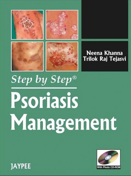 Psoriasis Management 1st Edition